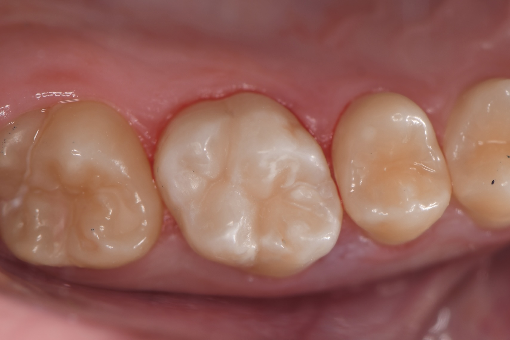 Пигментация или кариес?